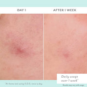 Before and after comparison of skin treatment on Day 1 and After 1 Week.