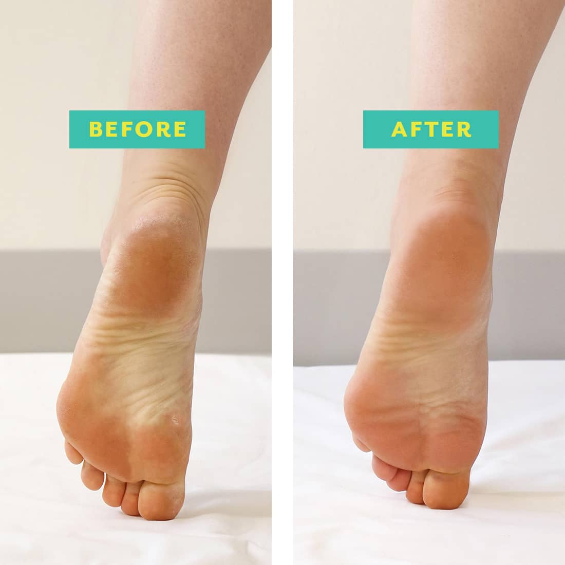 Foot Peel Mask To Exfoliate Dry Dead Skin Patchology Feet Peel