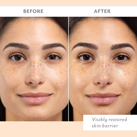 before and after skin remedy woman with brighter and less red skin visibly restored skin barrier