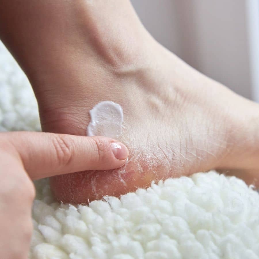 dry-cracked-feet-why-does-it-happen.jpg