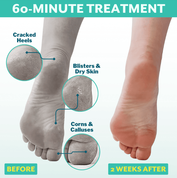 dry cracked heals and blisters