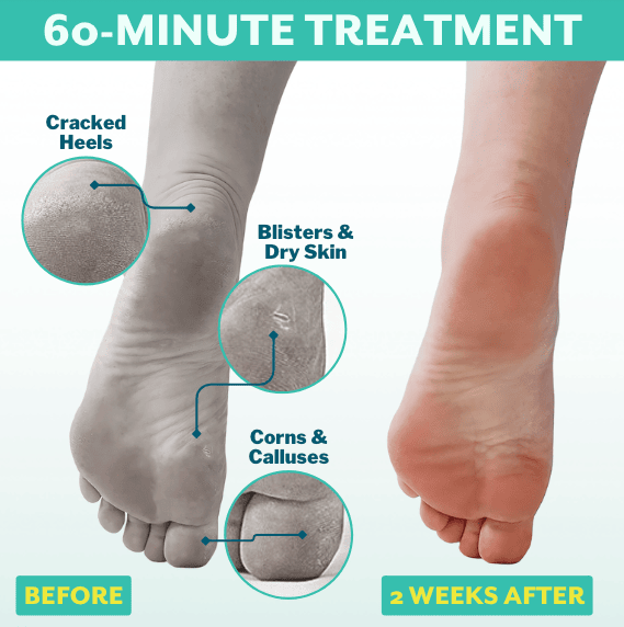 Foot Callus Remover Mask For Dead, Dry and Peeling Skin, Rough Heels Feet  Exfoliating Peel Scrub Results in Baby Soft, Silky, and Smooth Skin in 7-10
